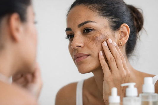 Exemplo de hiperpigmentação facial: causas